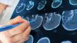 3D Beyin Taramaları DEHB Tanılarının Doğruluğunu Artırabilir